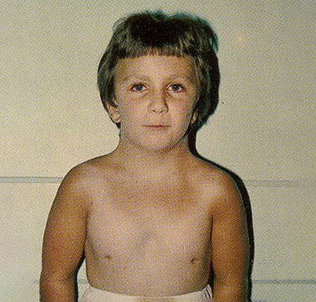 Sindromul Turner ➜ Ce este ➜ Tipuri ➜ Care sunt cauzele sindromului Turner ➜ Simptome ➜ Manifestari ➜ Complicatii ➜ Tratament ➜ Afla mai multe!