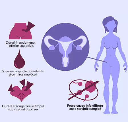 Ce este anexita? ➤ Care este diferenta intre cistita (raceala la ovare) & anexita? ➤ Simptome, cauze & metode de tratament ➤ Citeste aici mai mult!