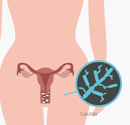 candidoza vaginala (Candida Albicans) - Simptome, Cauze, Tratament | Enroush