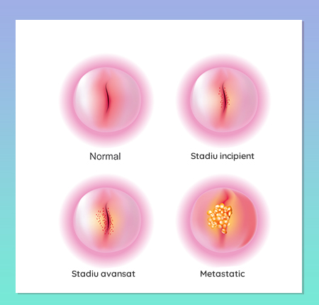 Cancerul de col uterin ➤ Simptome & Cauze ➤ Infectia cu HPV ➤ Diagnostic & Preventie ➤ Menstruatia cu cancer de col uterin ➤ Afla mai multe!