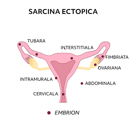 Ce este sarcina ectopica? ➤ Semne si simptome ➤ Cauze si depistare sarcina extrauterina ➤ Metode de tratament & recuperare ➤ Afla mai mult!