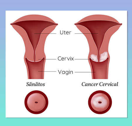 Cancerul de col uterin ➤ Simptome & Cauze ➤ Infectia cu HPV ➤ Diagnostic & Preventie ➤ Menstruatia cu cancer de col uterin ➤ Afla mai multe!