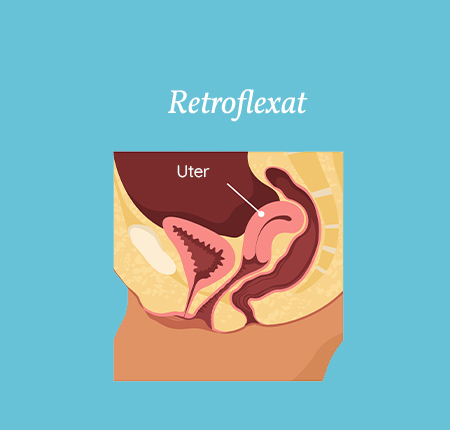 TOT ce trebuie sa stii despre uterul retrovers ➤ Uter retrovers in sarcina ➤ Fertilitate & viata sexuala cu uter retrovers ➤ Simptome & Cauze ➤ Mai multe aici!