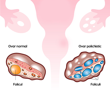 Ce este sindromnul ovarelor polichistice? ➤ Simptome, Cauze & Tratament ➤ Ovare polichistice in sarcina ➤ Afla aici mai mult!  